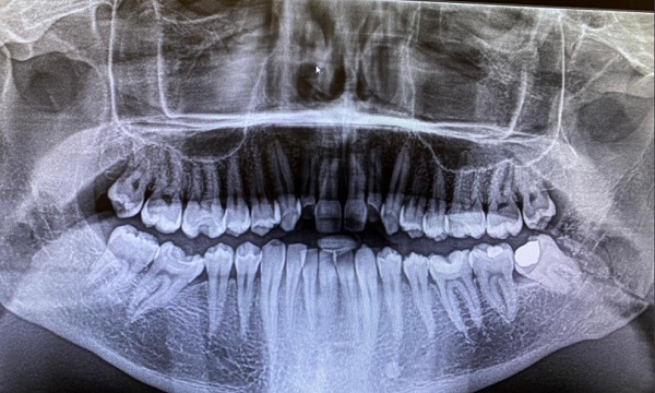 WarringtonJaw